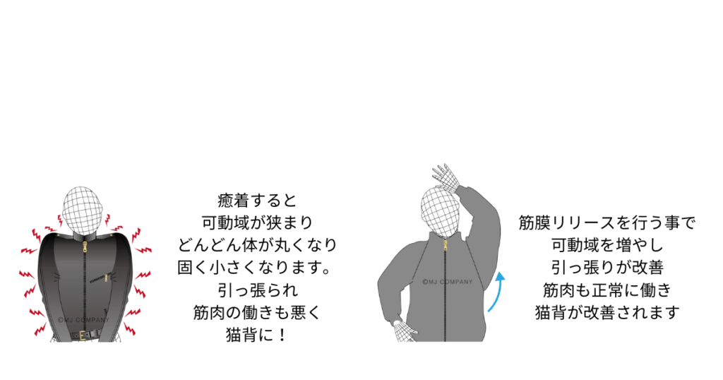 筋膜リリース